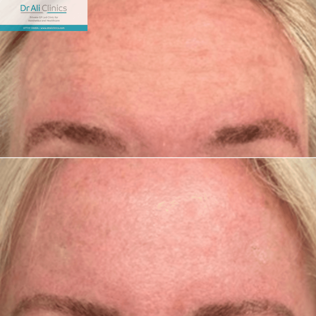 Forehead lines - Before and After