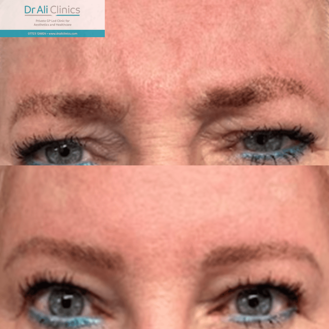Glabellar lines - Before and After