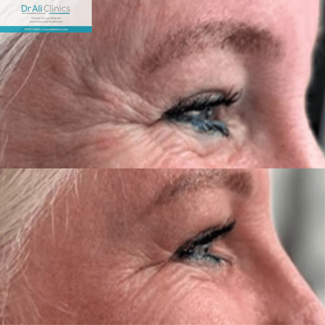 Crows feet - Before and After