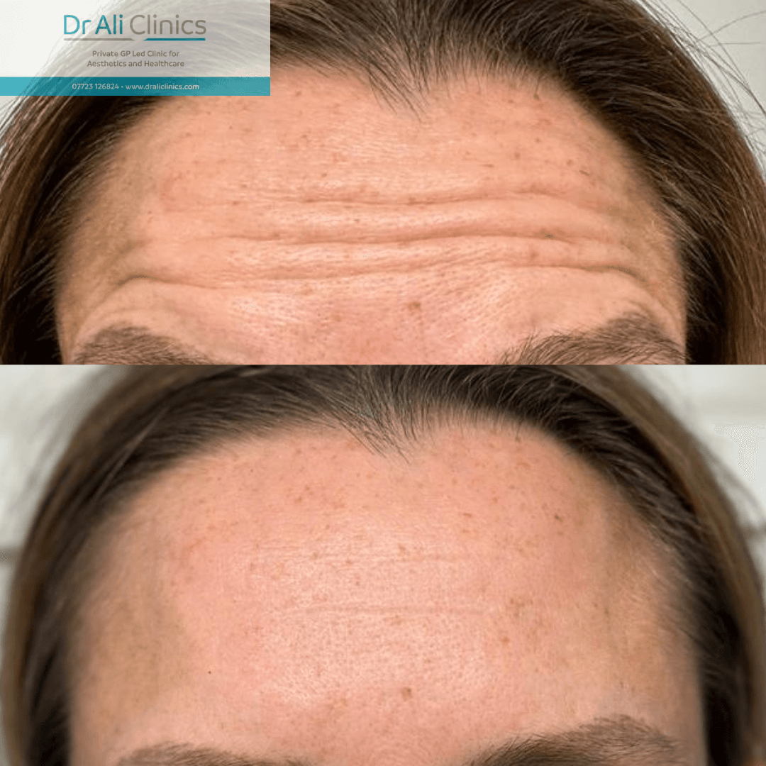 Forehead lines - Before and After