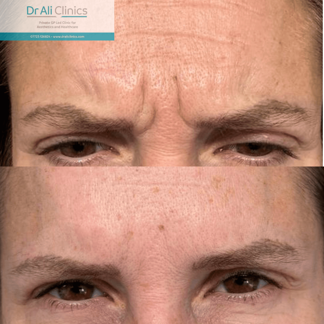 Glabellar lines - Before and After