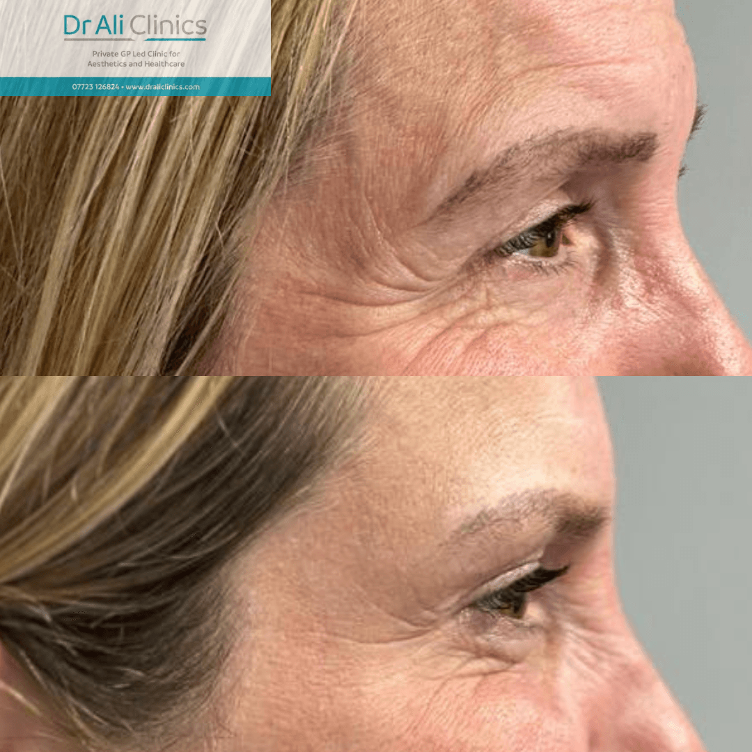 Crows feet - Before and After