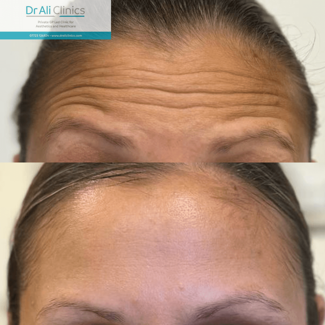 Forehead lines - Before and After