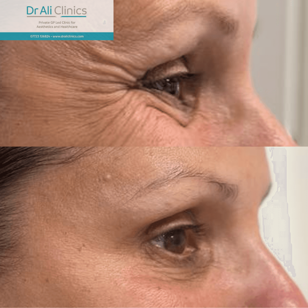 Crows feet - Before and After