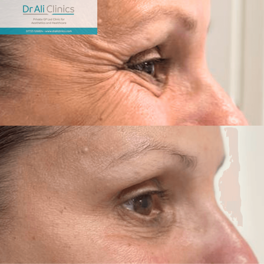 Crows feet - Before and After