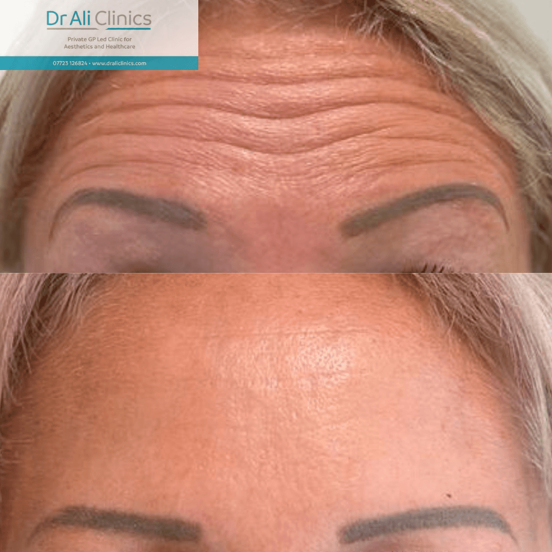 Forehead lines - Before and After