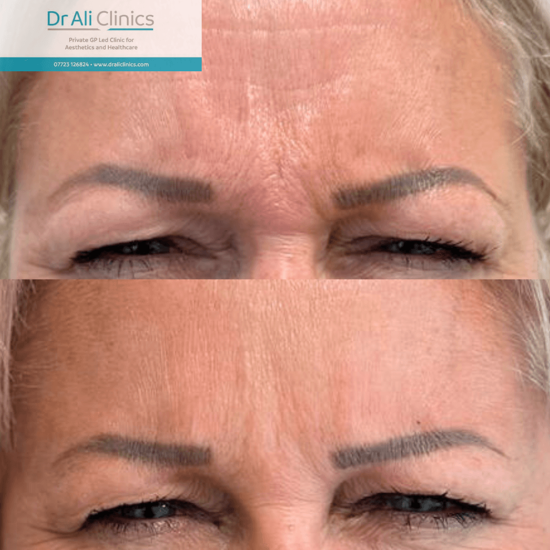 Glabellar lines - Before and After