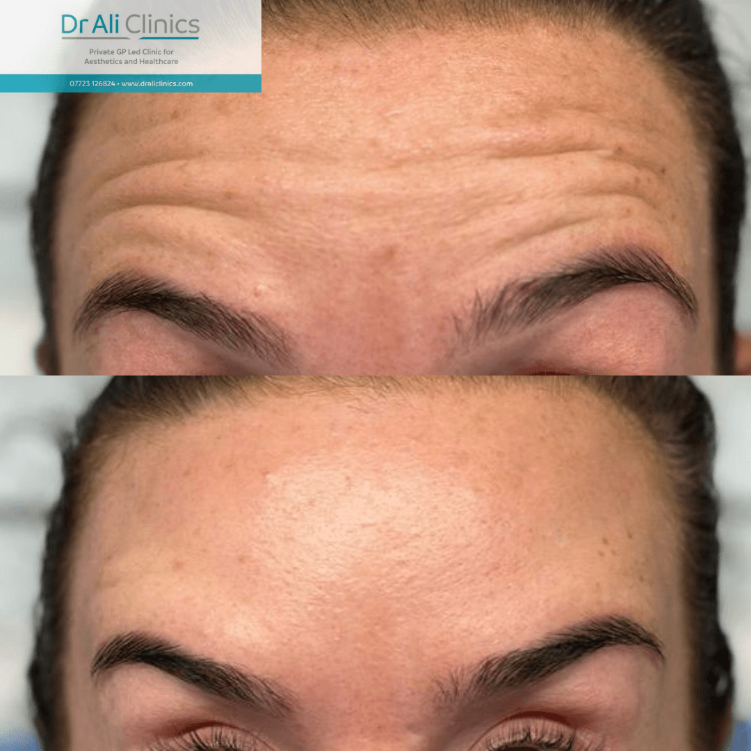Forehead lines - Before and After