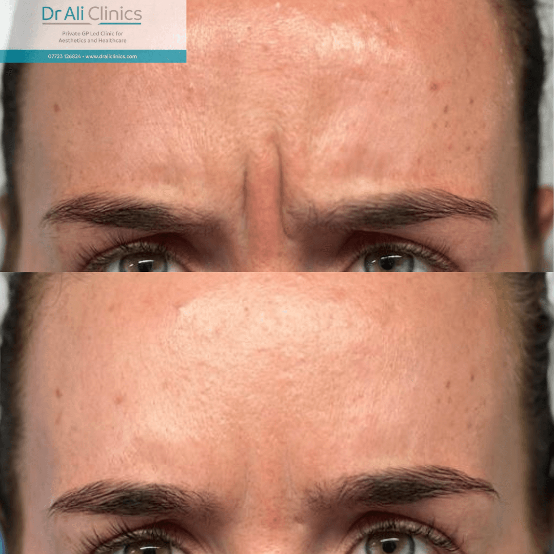 Glabellar lines - Before and After