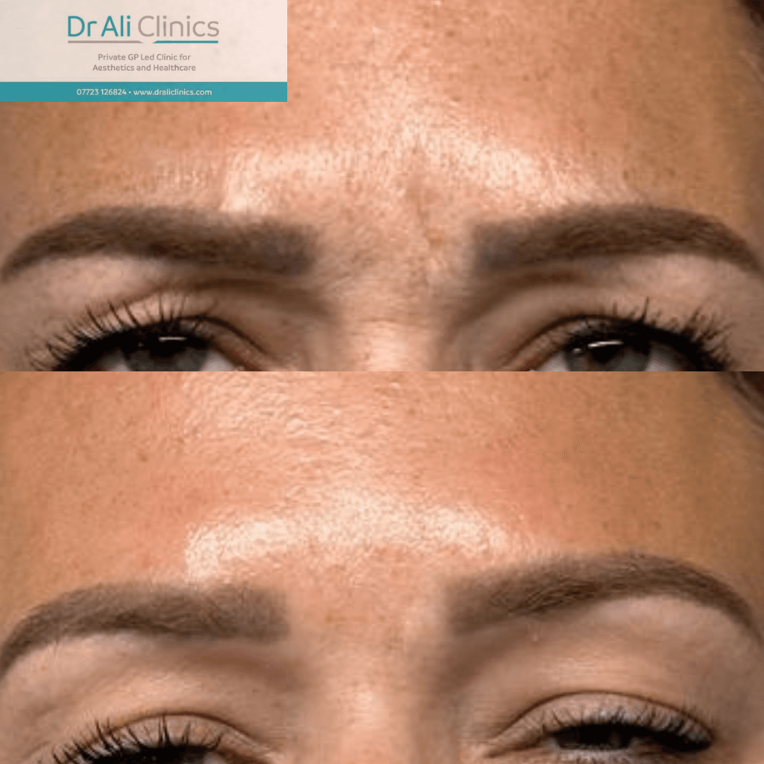Glabellar lines - Before and After