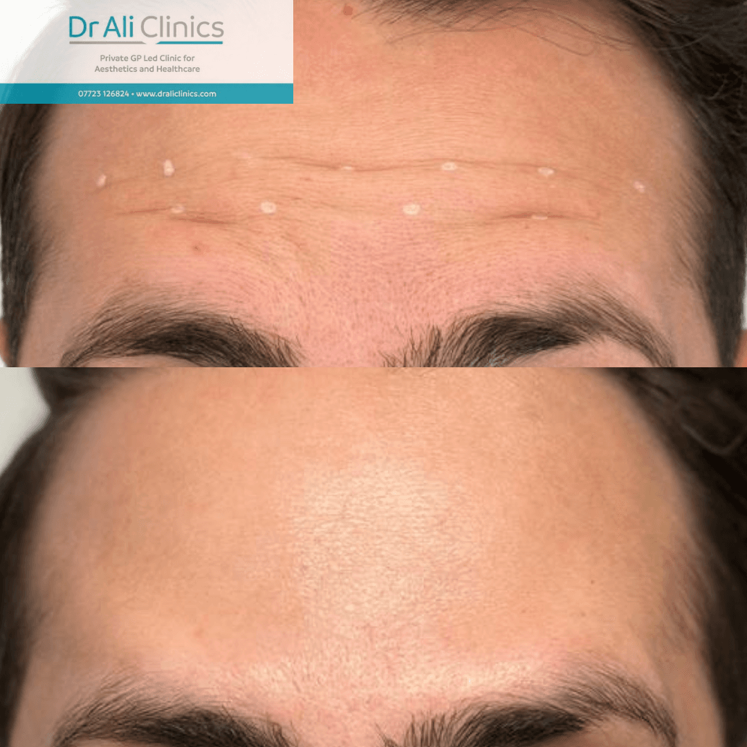 Forehead lines - Before and After