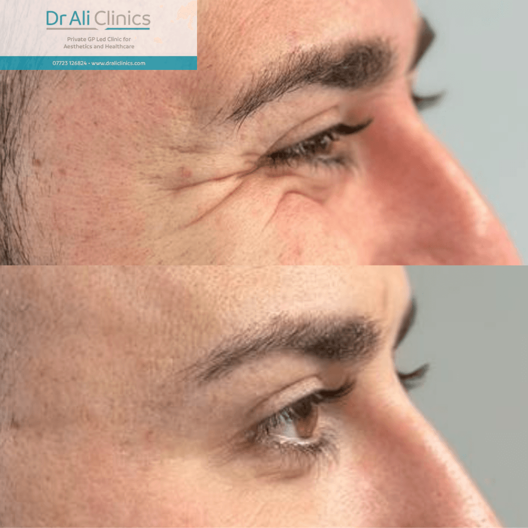 Crows feet - Before and After