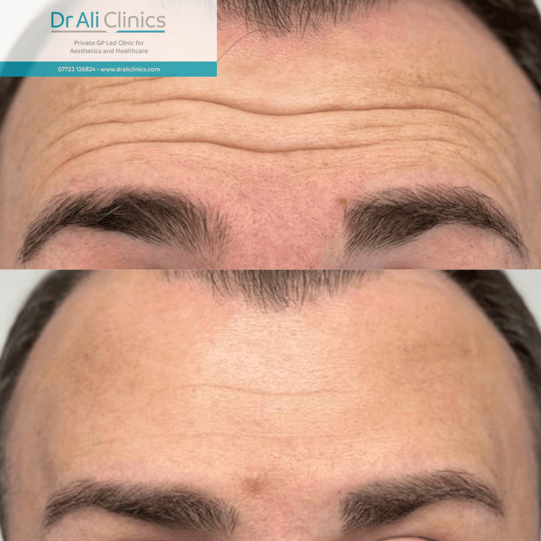 Forehead lines - Before and After
