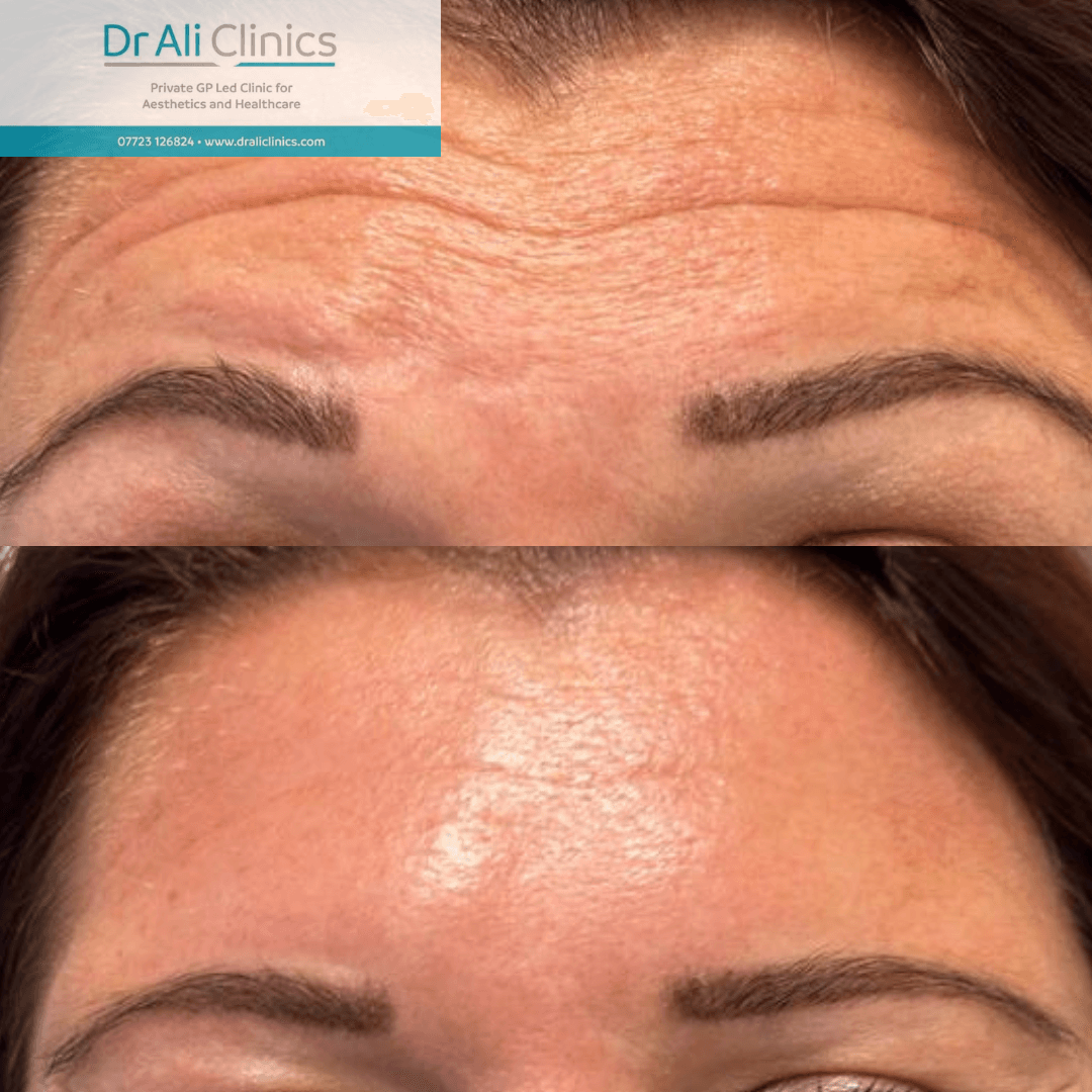 Forehead lines - Before and After