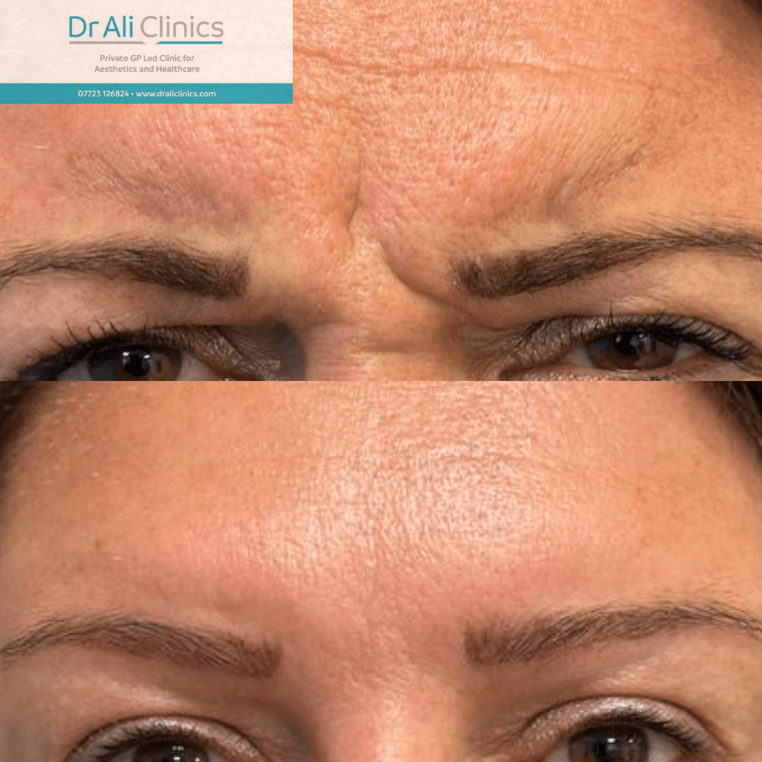 Glabellar lines - Before and After