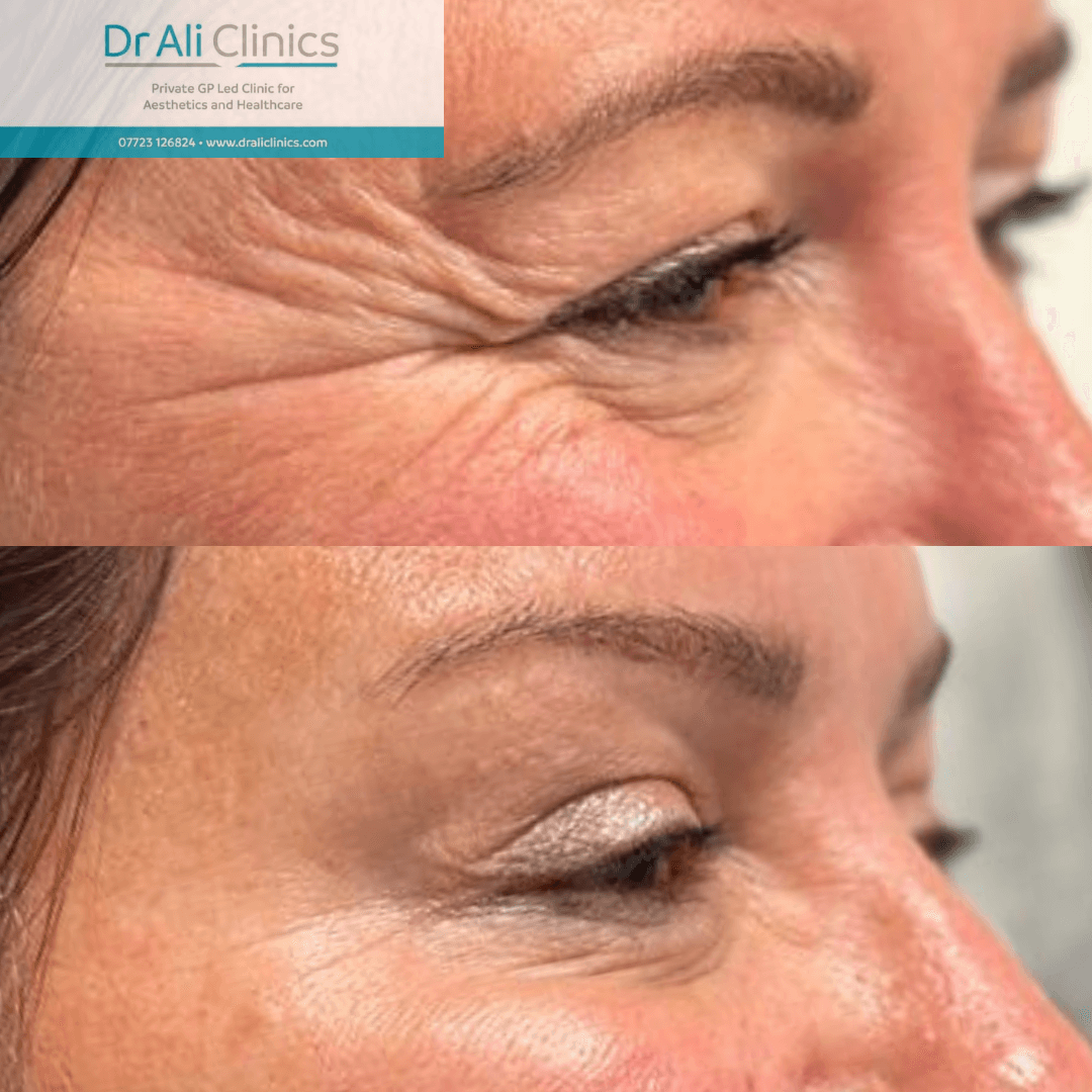 Crows feet - Before and After