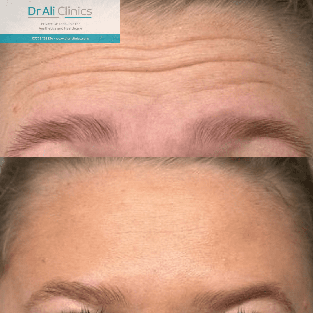 Forehead lines - Before and After