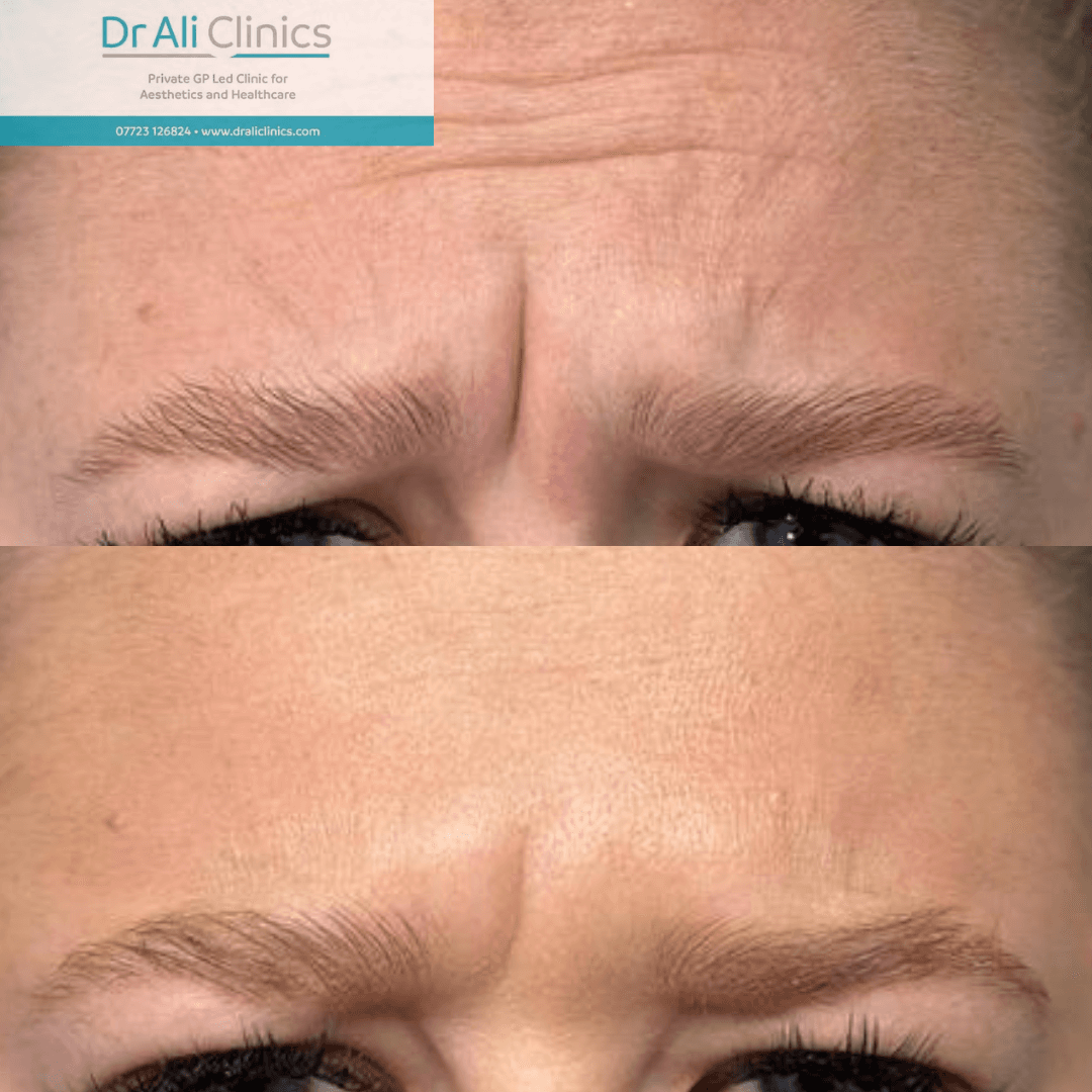 Glabellar lines - Before and After