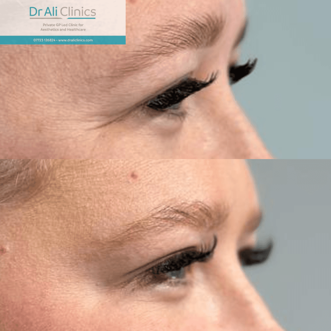 Crows feet - Before and After